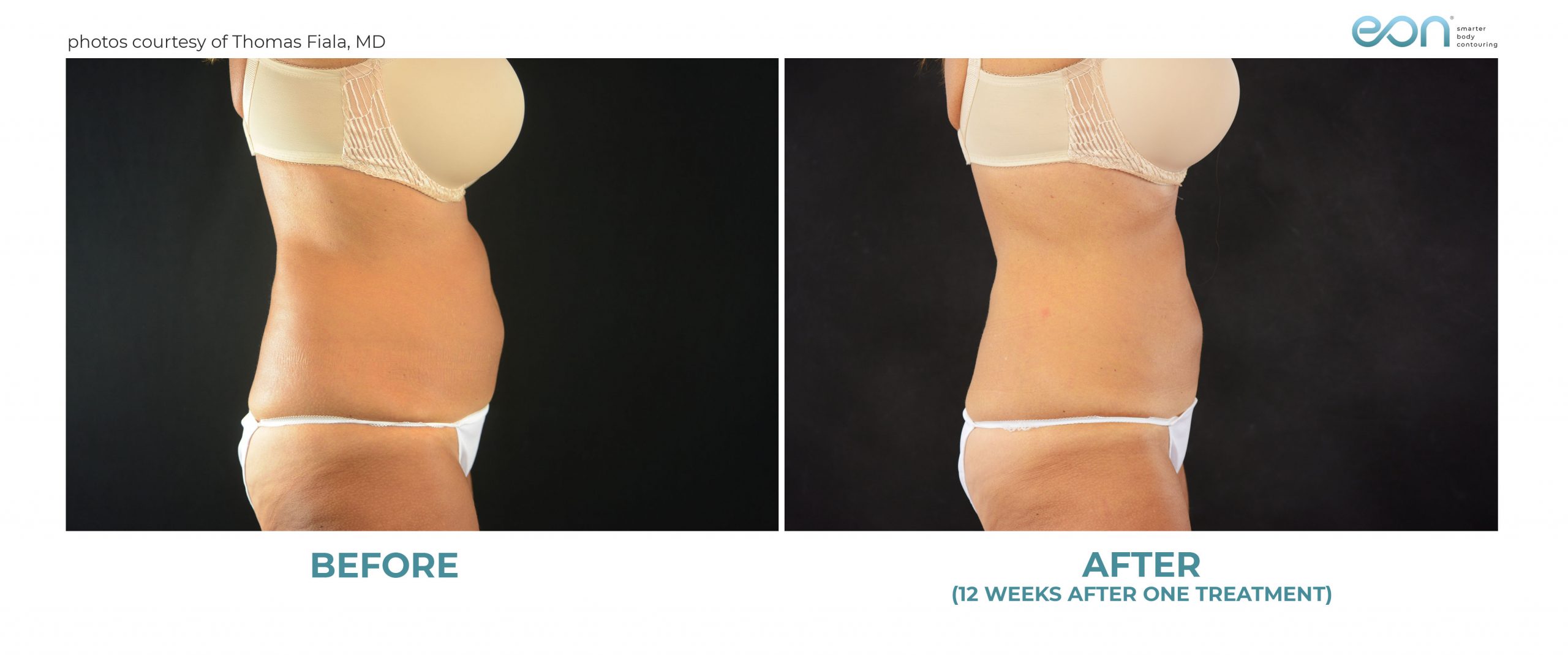 EON® Body Contouring Laser before and 12 weeks after one treatment