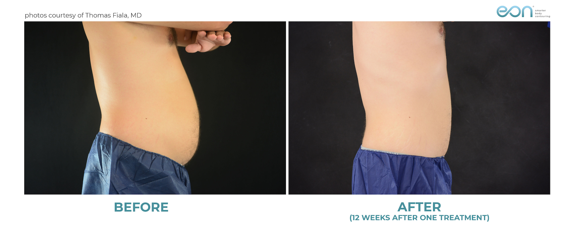 EON® Body Contouring Laser before and 12 weeks after one treatment
